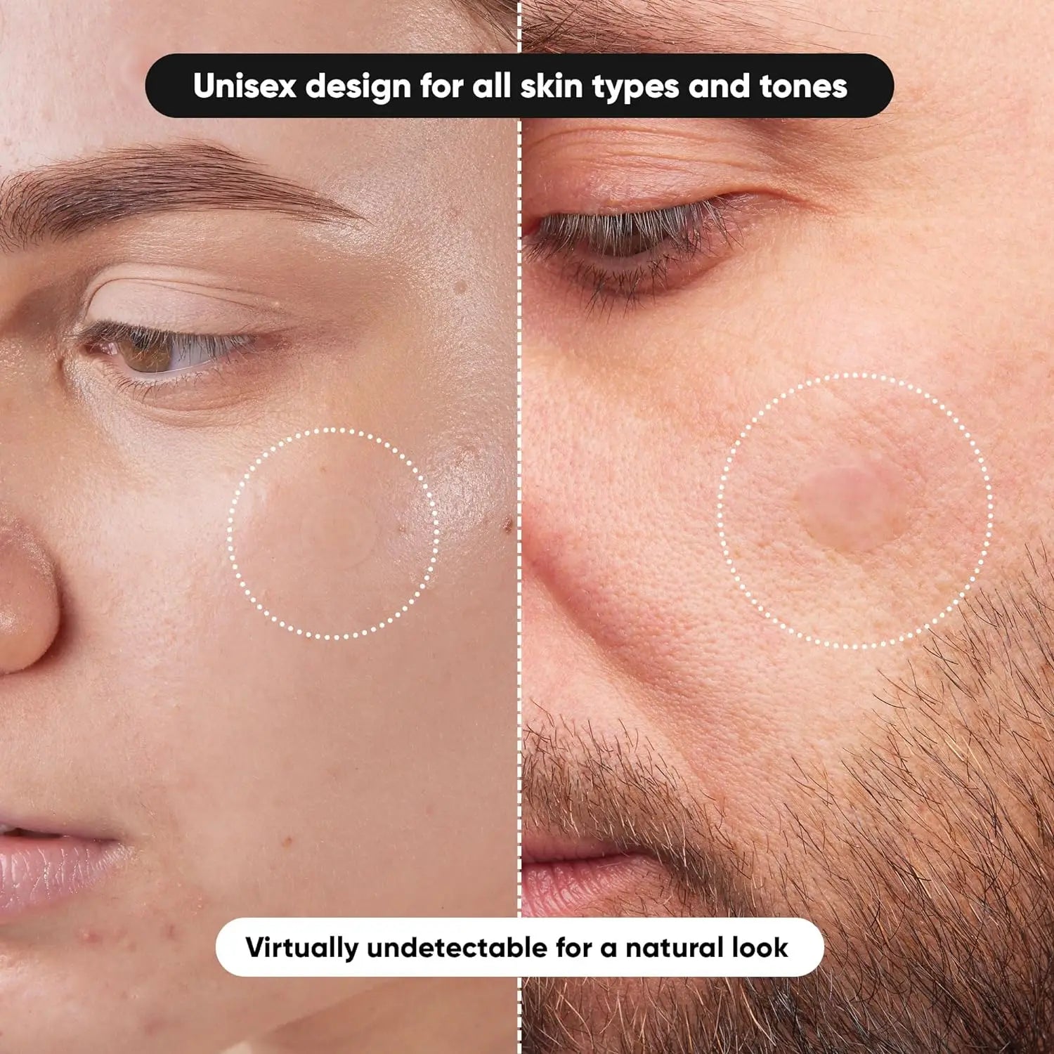 Gentle Non-Irritating Hydrocolloid Acne Patch